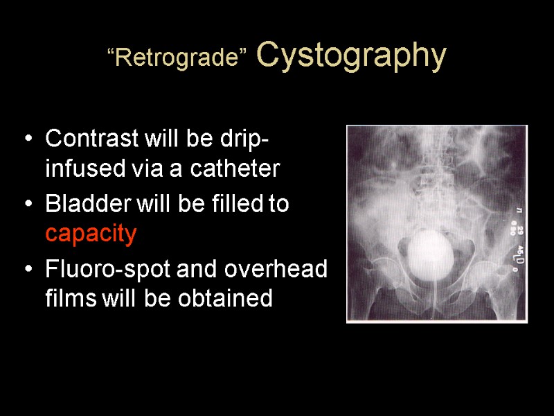 “Retrograde” Cystography Contrast will be drip-infused via a catheter Bladder will be filled to